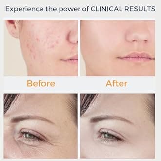 Dermati High Frequency Facial Machine- Portable Handheld High Frequency Facial Wand/Neon