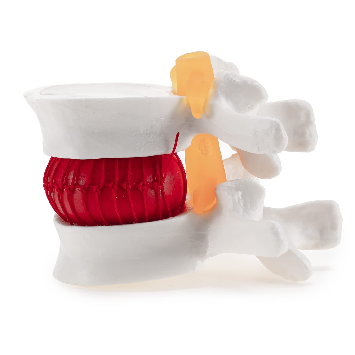 Winyousk Human Intervertebral Disc Herniation Model, eEducational Display Tool, Anatomical Model of Lumbar Disc Herniation, Medical Teaching and Learning Model