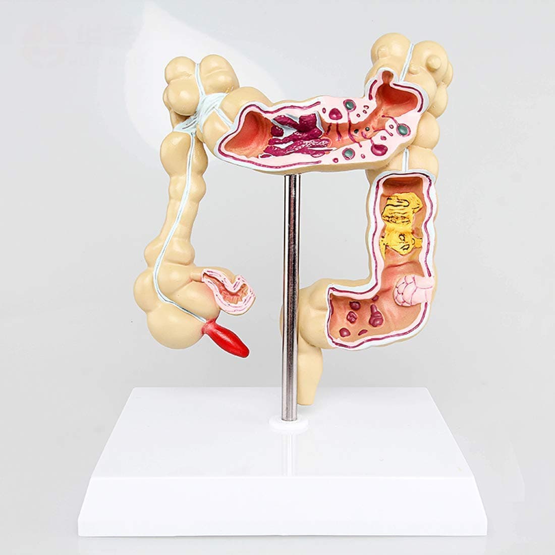 QHYXT Educational Model Large Intestine Colon Pathology Model Rectal Tail Model Pathological Anorectal Cancer Doctor-Patient Communication Mode
