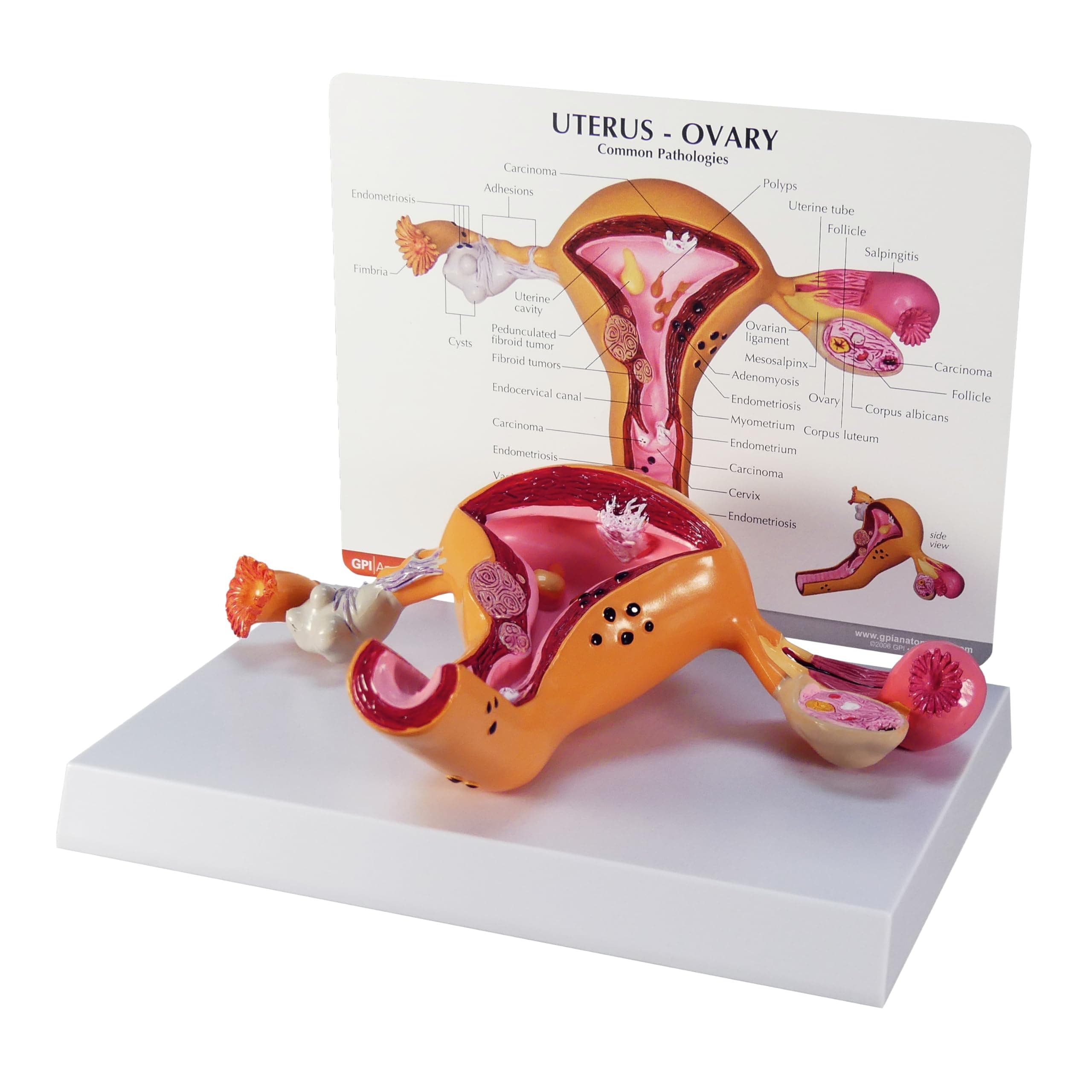 Uterus Ovary Anatomical Model With Pathologies/Key Card